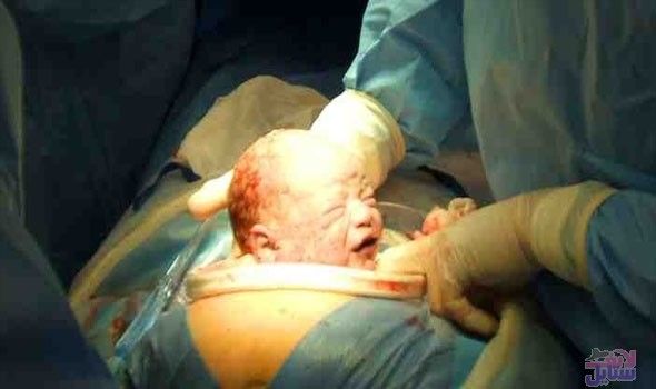 دراسة فرنسية تُؤكد أن الولادة القيصرية تسبب مضاعفات خطرة للنساء