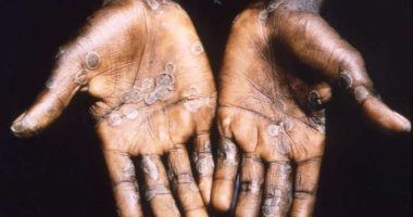 "الخطر القادم".. كل ما تريد معرفته عن جدرى القرود