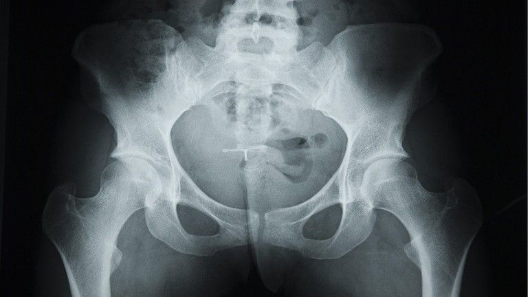 رجل يكتشف أن عضوه الذكري صار عظما .. شاهد لماذا وكيف؟