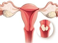 أبرزها سرطان الثدي.. 4 أنواع سرطان تصيب النساء