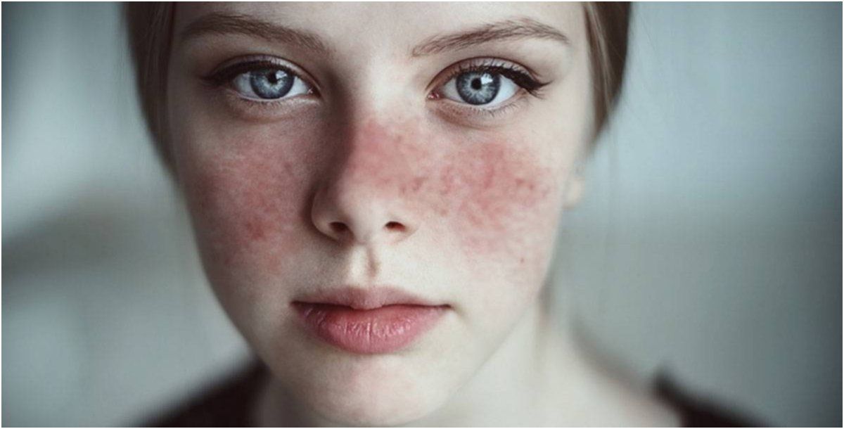 "الذئبة المُزمن" مرض يهاجم الجهاز المناعي ويهدد الحياة.. وهذه محفزاته!