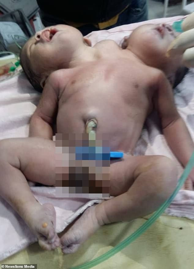 شاهد حالة نادرة في الهند.. ولادة طفل برأسين و3 أذرع لا يمكن الفصل بينهما