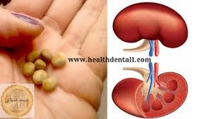 شاهد.. مشروب بسيط سيخلصك من المعاناة يفتت الحصى ويقضي على آلام الكلى إلى الأبد (تعرف عليه)