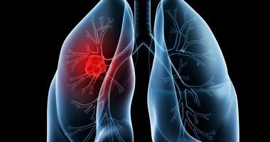 كيف تحمى نفسك من التهاب الشعب الهوائية الحاد؟