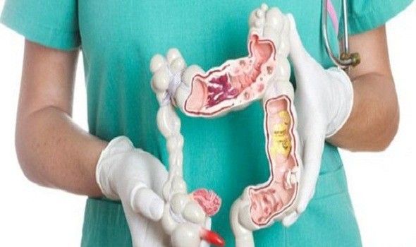 تعرف علي أهم الأمراض الشائعة التي تؤثر علي القولون