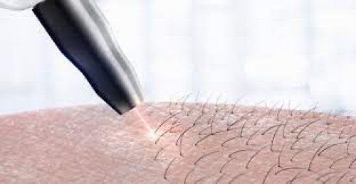 افضل جهاز ليزر منزلي،جهاز براون لازالة الشعر