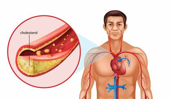 لا تتجاهلها.. علامات خطيرة في ساقيك تكشف أن الكوليسترول أصبح قاتلاً