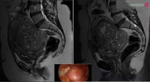استئصال ورم بطني ضخم بعملية منظار دقيقة بمستشفى الدكتور سليمان الحبيب