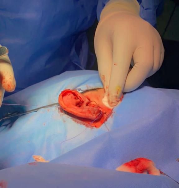 إصلاح أذن فتاة "عشرينية" في مستشفى القويعية العام