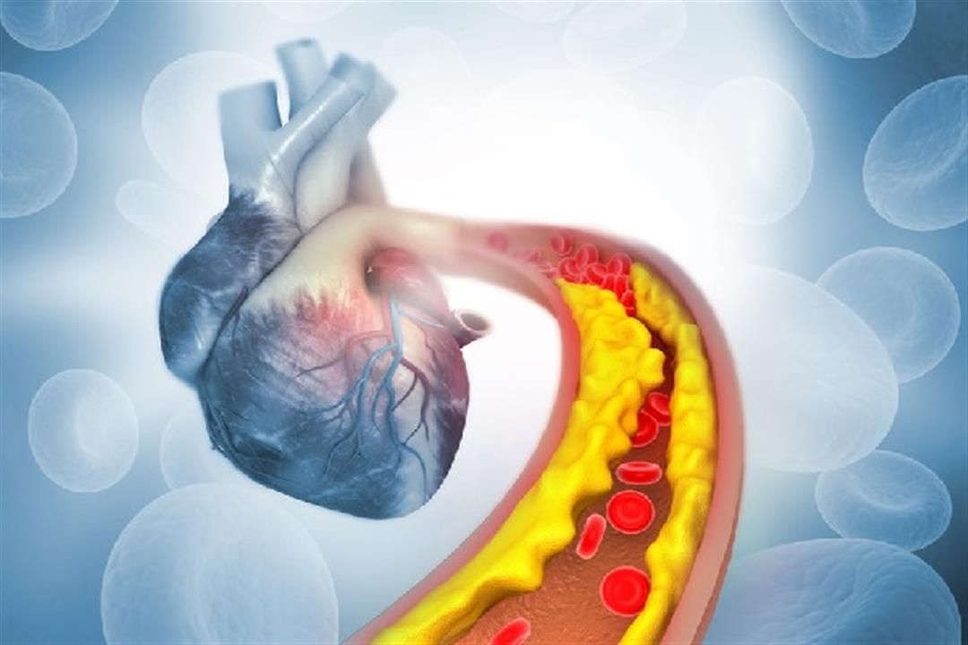 اذهب للطبيب فورا..5 أعراض تشير إلى انسداد الشرايين
