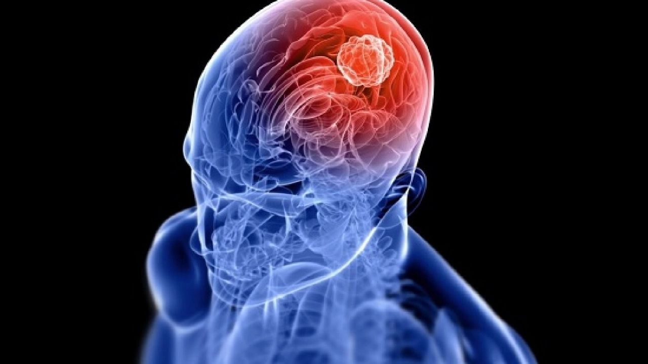 ضعف الذاكرة علامة ترتبط بهذه المشكلات الصحية