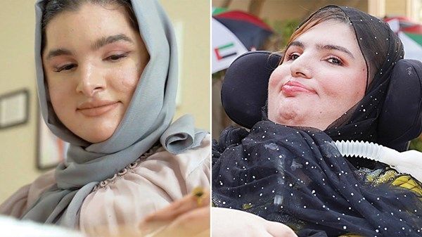 «بارقة أمل» لشقيقتين مصابتين بأمراض مزمنة