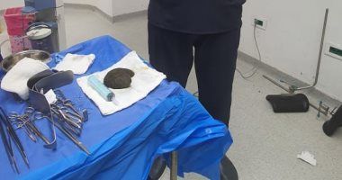 حالة نادرة.. فريق طبى بجامعة الأزهر يستخرج 2 كيلو شعر من معدة فتاة