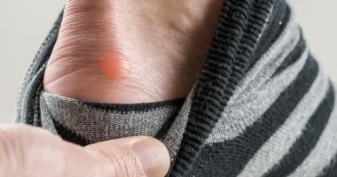 أسباب الإصابة ببثور تحت الابط.. أبرزها الالتهابات والعدوى