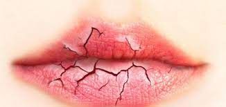 بدون أدوية.. علاجات منزلية سريعة ورخيصة لـ الشفاه المتشققة