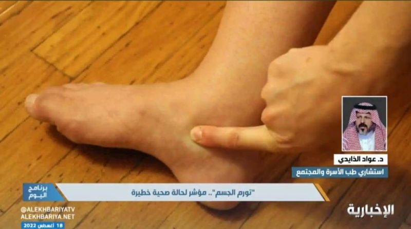 استشاري" سعودي يكشف أسباب تورم الجسم و علاقته بالإصابة بهذه الأمراض