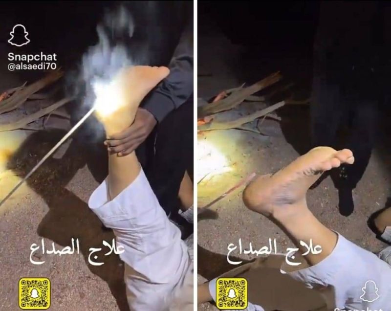 شاهد .. أغرب طريقة لعلاج الصداع بكي القدمين من الكعب!