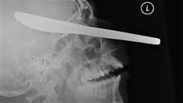 رجل ينجو بأعجوبة من مسمار اخترق عينه واستقر في دماغه