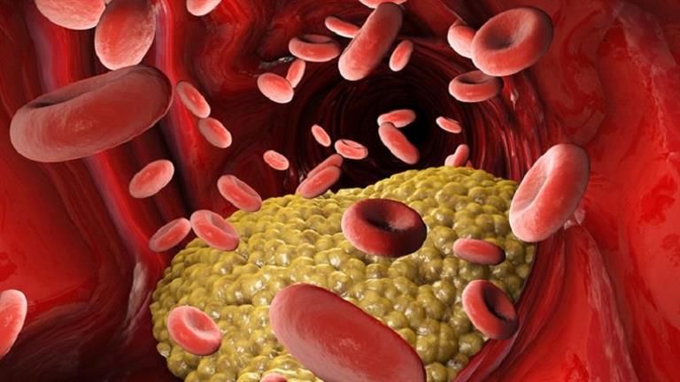 4 علامات حول عينيك دليل على ارتفاع الكوليسترول.. احذرها