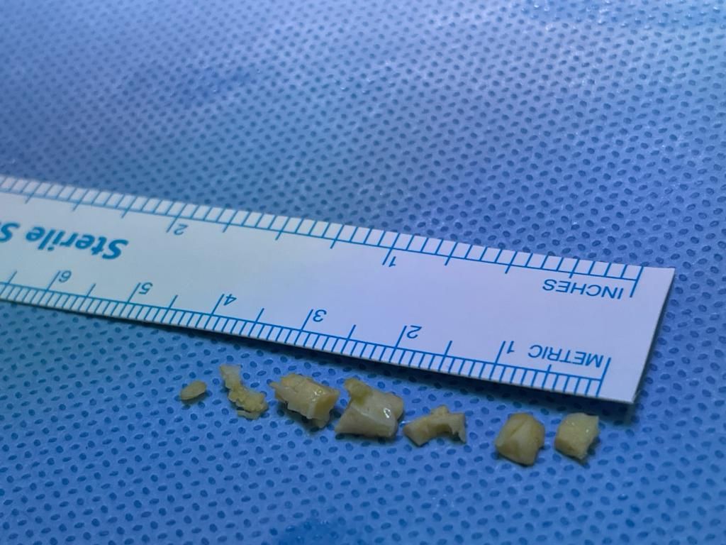 "حبات ترمس" كادت أن تقضي عليه.. مجمع الملك فيصل بالطائف ينقذ رضيعًا من الاختناق