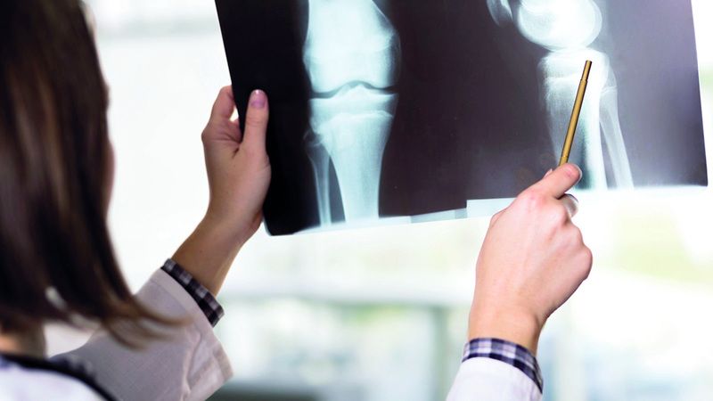 الامارات | علامات الإصابة بـ «هشاشة العظام».. وطرق المواجهة