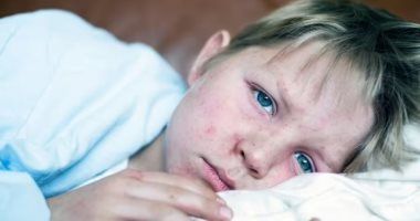 4 أسئلة توضح حقيقة الحصبة بعد تفشى المرض فى إنجلترا