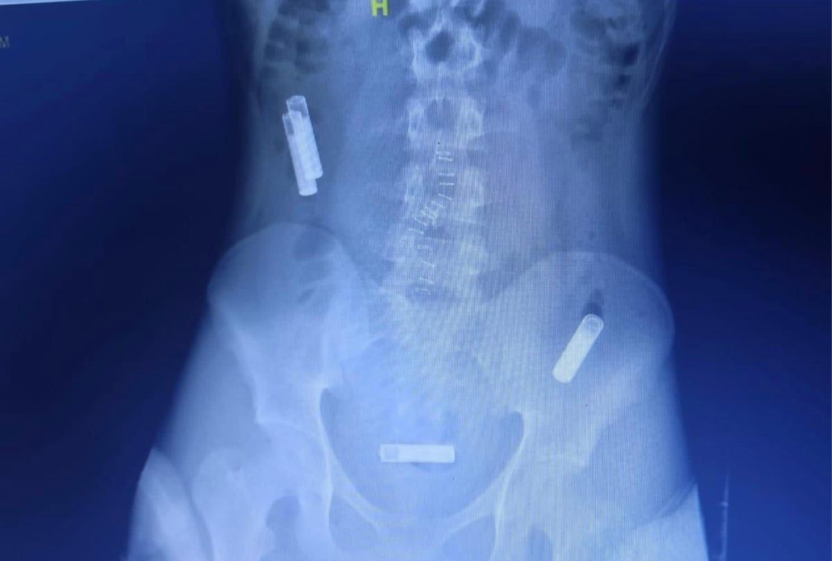 عبر المنظار الجراحي.. استخراج 3 بطاريات ريموت تلفزيون من بطن مريض نفسيّ بمكة