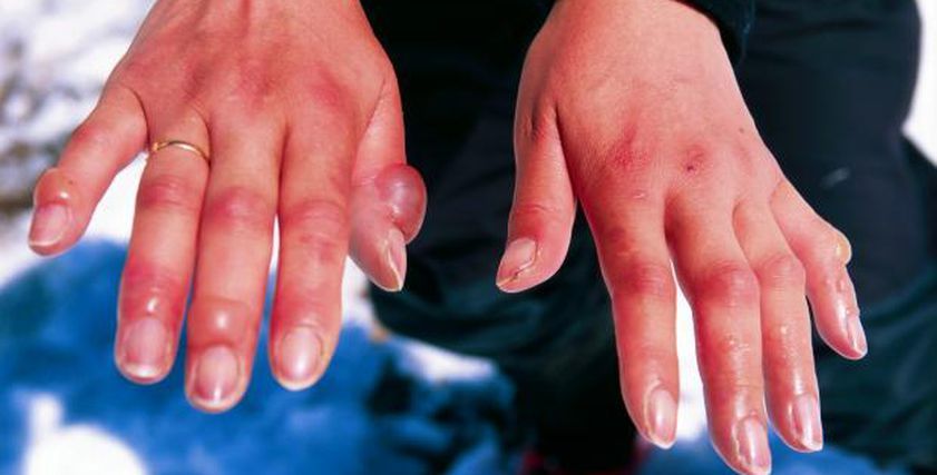 كل ما تريد معرفته عن عضة البرد.. لماذا تصيب الأطراف في الشتاء فقط؟