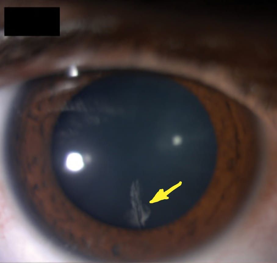 إضافة سعودية عالمية في طب العيون.. "قيراط" يكتشف علامة جديدة لدى مرضى القرنية المخروطية