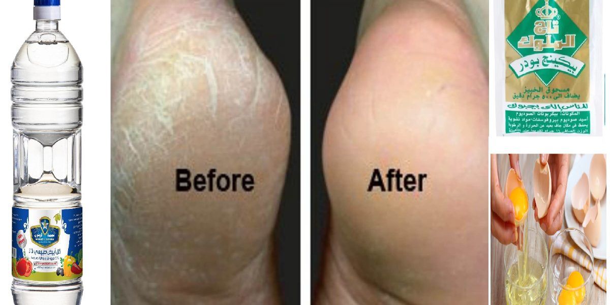 خلطة سحرية للتخلص من تشققات الكعبين واسمرار القدم والركبتين في يوم واحد بس