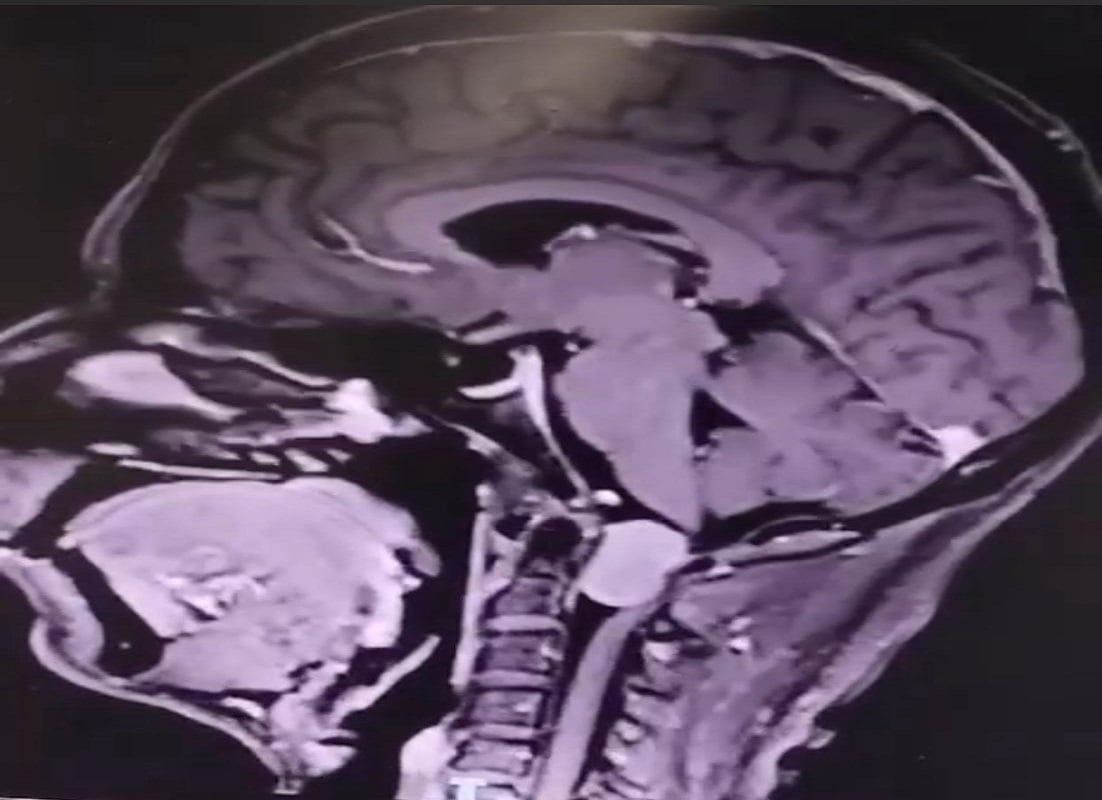 استغرقت 3 ساعات.. جراحة دقيقة بـ"سعود الطبية" تُعيد الحركة لمريض بعد شلل الطرف الأيسر