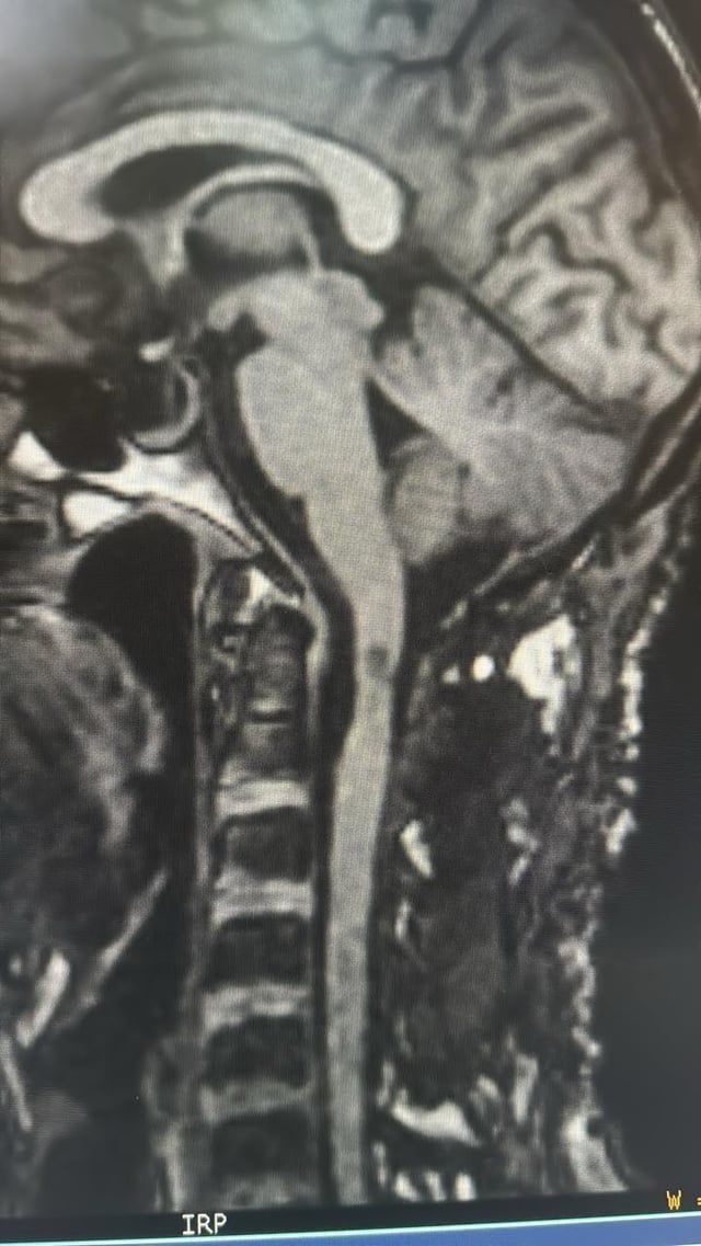 استغرقت 3 ساعات.. جراحة دقيقة بـ"سعود الطبية" تُعيد الحركة لمريض بعد شلل الطرف الأيسر