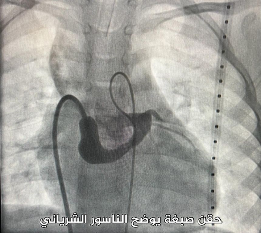 قسطرة قلبية تنقذ طفل من جلطة وفشل بعضلة القلب في القصيم