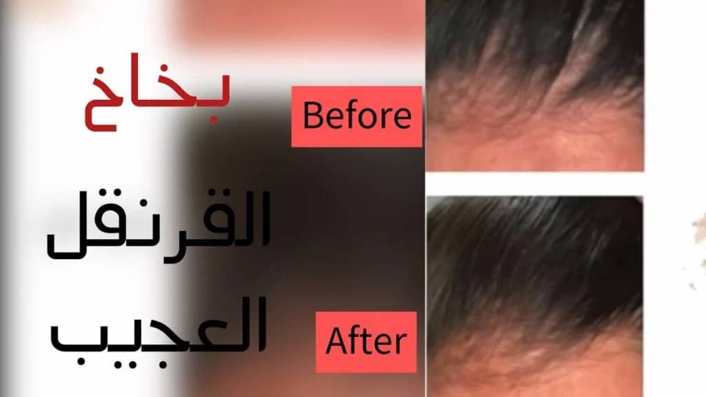 بخاخ القرنفل الرهيب لتكثيف الشعر وإنبات الفراغات ومقدمة الرأس بسرعة الصاروخ