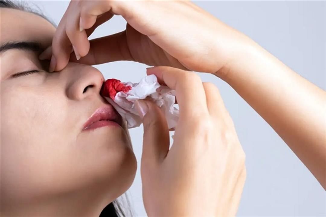 ما هي أسباب وعلاج نزيف الأنف؟