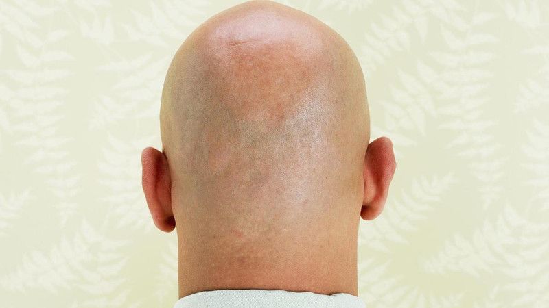 الكشف عن علاج متوفر بكل الصيدليات يقضي على الصلع نهائياً !