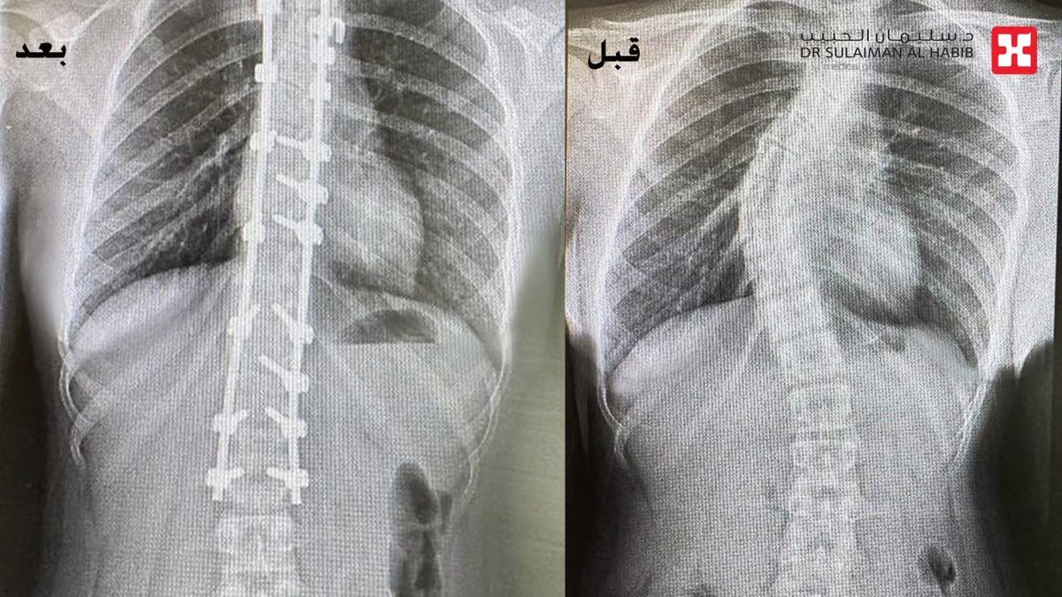 السعودية | مستشفى الدكتور سليمان الحبيب بالعليا يُعيد فتاة لحياتها الطبيعية بعد جراحة جنف متقدمة استغرقت 5 ساعات