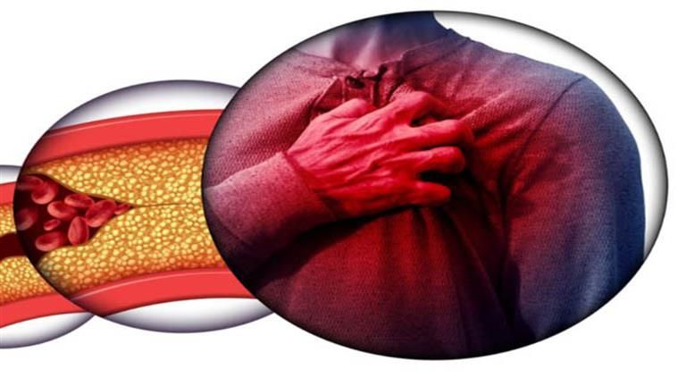 3 علامات تشير إلى تطور تصلب الشرايين