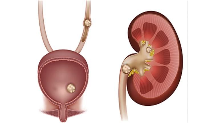 أعراض إذا ظهرت عليك تشكل خطر الإصابة بحصوات الكلى