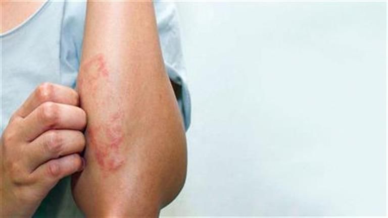 علامات تدل على الإصابة بسرطان الجلد.. اكتشفه مبكرا