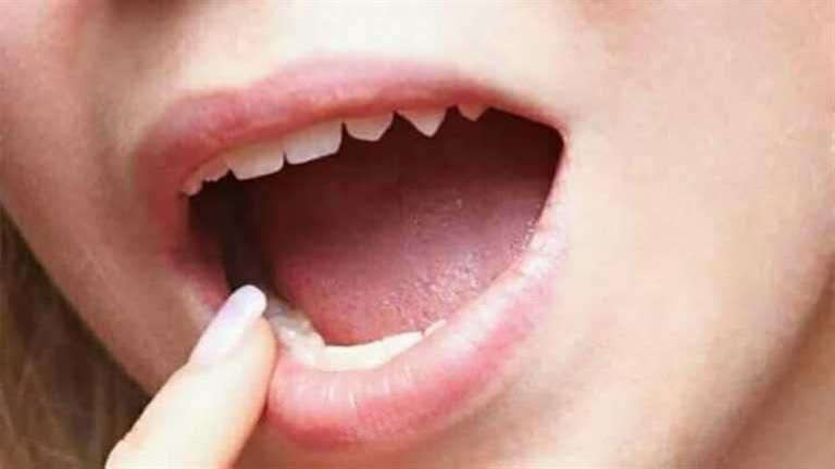 أعراض إذا ظهرت على اللسان تدل على مرض خطير