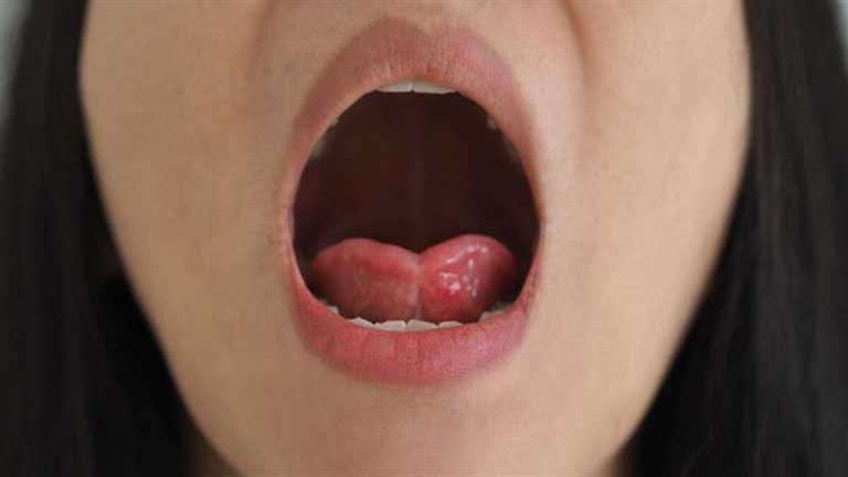 ماذا تفعل عند حرق لسانك بعد تناول مشروب ساخن؟ .. علاج بطرق بسيطة
