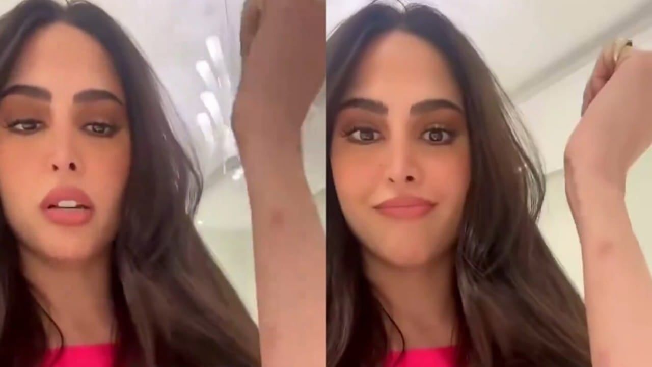 شاهد فوز الفهد تثير الجدل بظهورها بكدمات في يدها