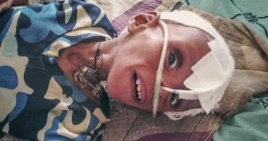 "يونيسف": 10 ملايين طفل يمني يعانون سوء التغذية الحاد