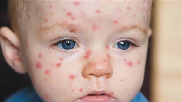 أطباء بلا حدود: مئات الأطفال يعانون من الحصبة في جنوب السودان