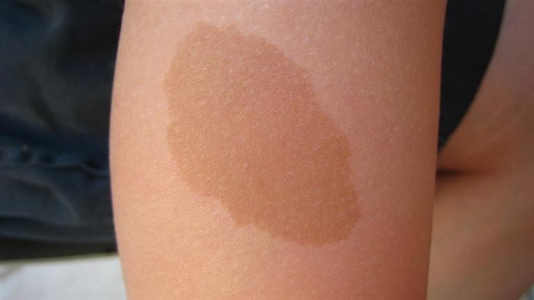 بقع "القهوة بالحليب" على جسد الأطفال.. علام تدل؟