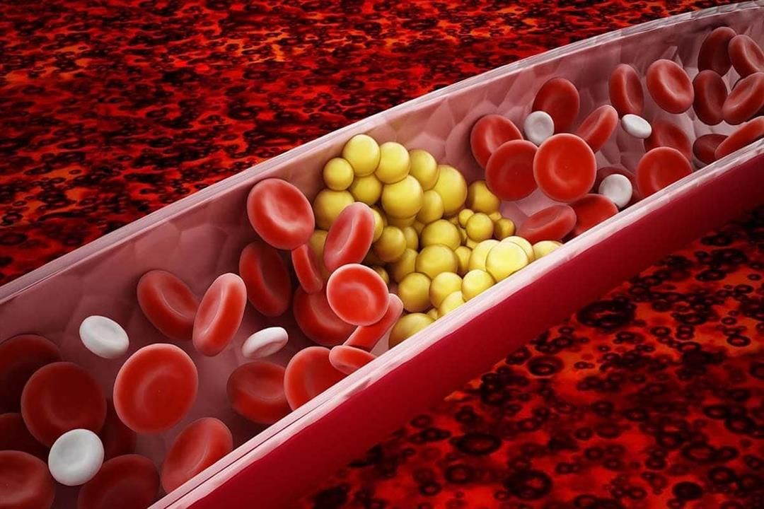 دواء جديد يُخفض مستويات الدهون الثلاثية بنسبة 50%.. تعرف عليه