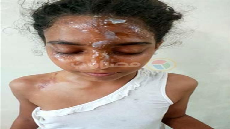 3 صور| حرق طالبة بمياه مغلية.. و"التعليم" تكشف آخر تطورات التحقيق في الواقعة