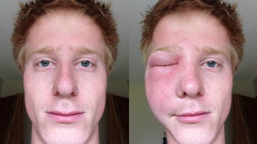 داسوا على عشها.. إصابة ١٢ جنديا إسرائيليا بلسعات دبابير في غزة