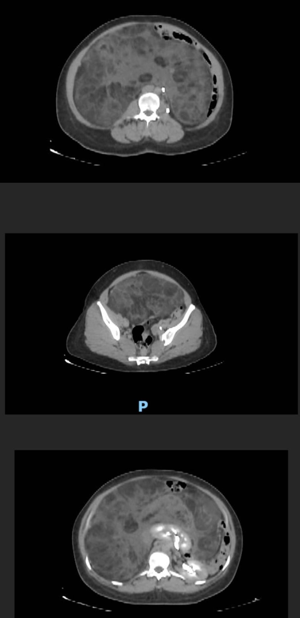 "سعود الطبية" تنهي معاناة ثلاثينية من ورم نادر يزن 9 كجم